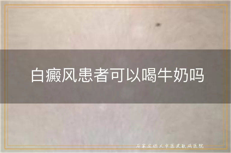 白癜风患者可以喝牛奶吗