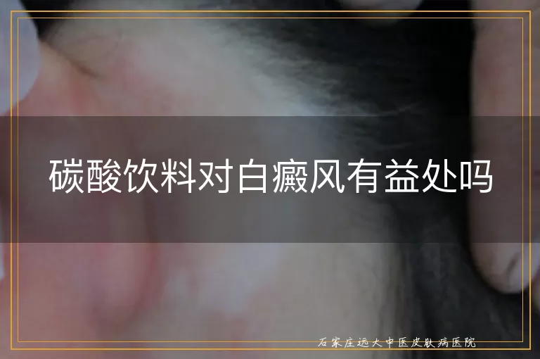 碳酸饮料对白癜风有益处吗