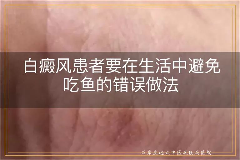 白癜风患者要在生活中避免吃鱼的错误做法