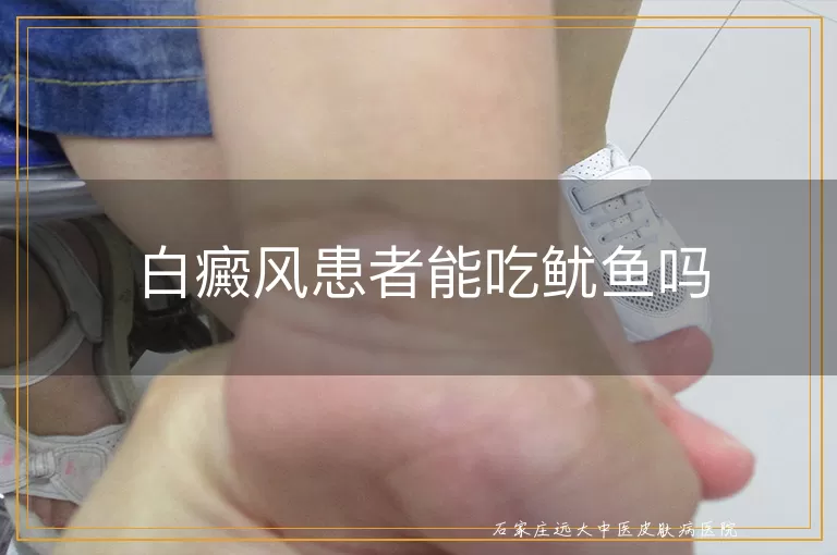 白癜风患者能吃鱿鱼吗