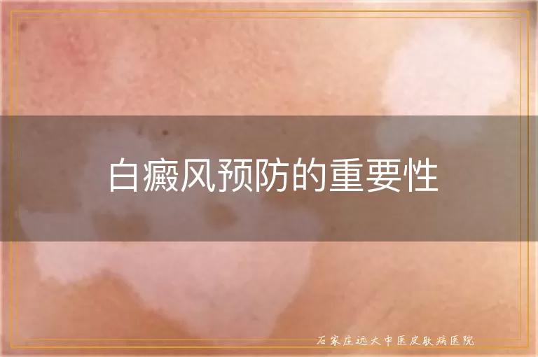 白癜风预防的重要性