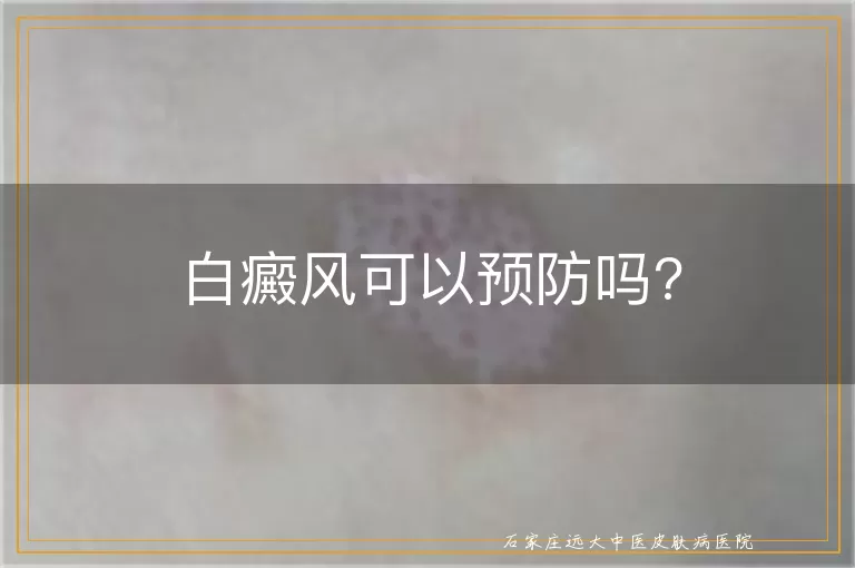 白癜风可以预防吗?