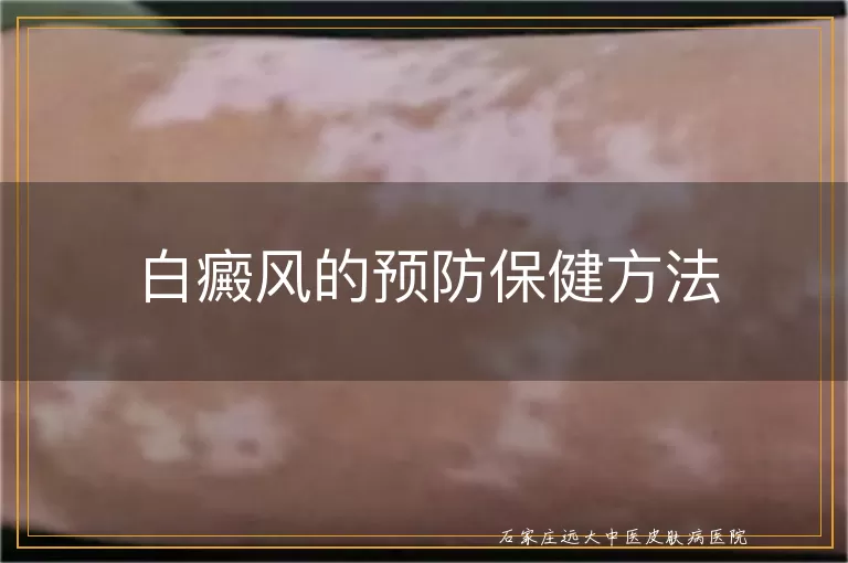 白癜风的预防保健方法
