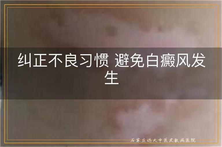 纠正不良习惯 避免白癜风发生