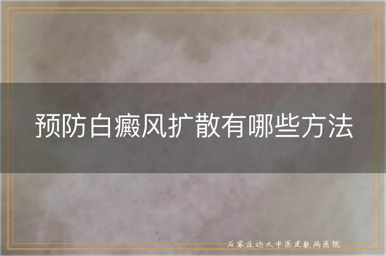 预防白癜风扩散有哪些方法