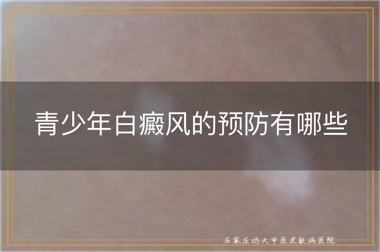 青少年白癜风的预防有哪些