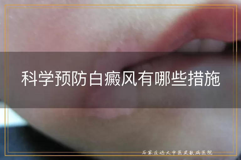 科学预防白癜风有哪些措施