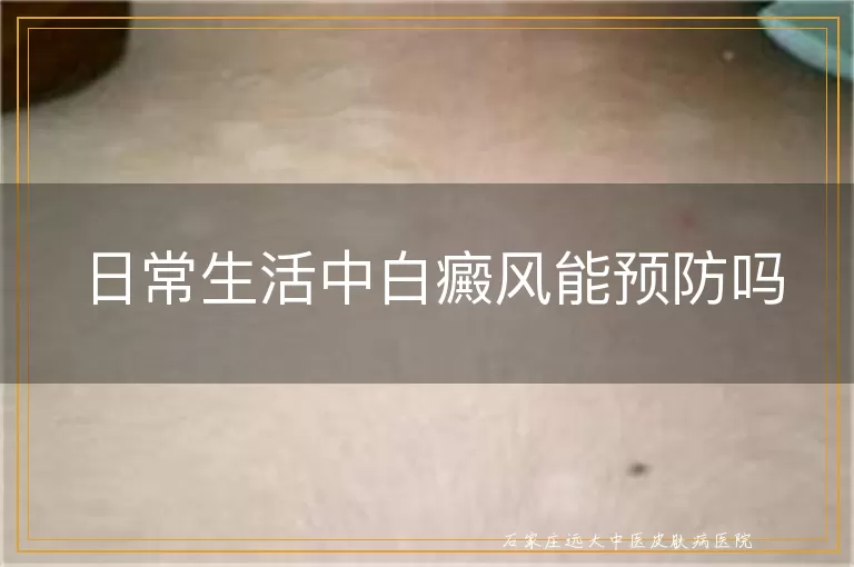 日常生活中白癜风能预防吗