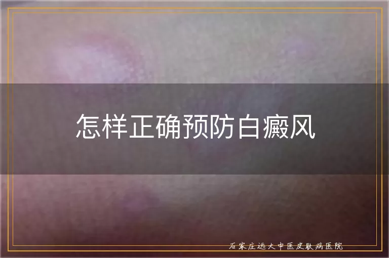 怎样正确预防白癜风