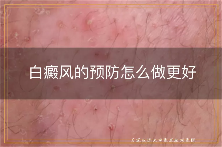 白癜风的预防怎么做更好