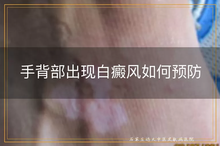 手背部出现白癜风如何预防