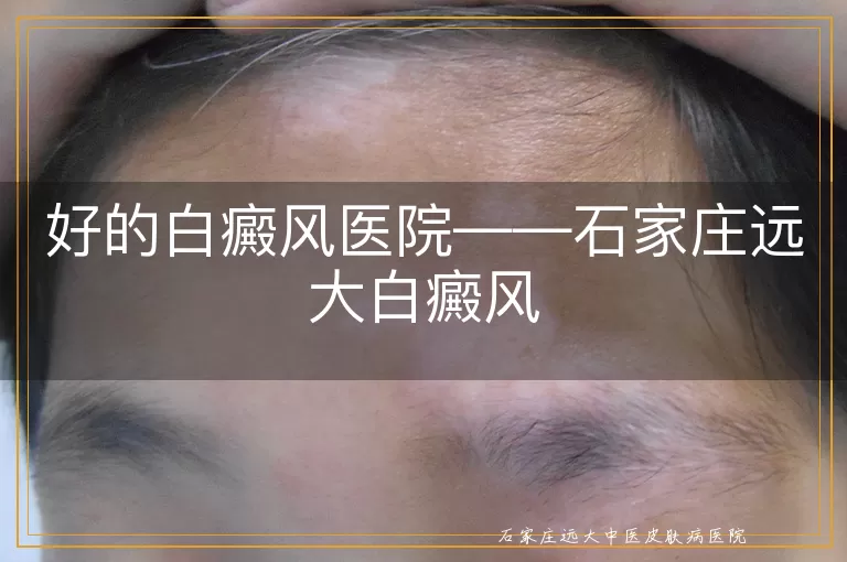 好的白癜风医院——石家庄远大白癜风
