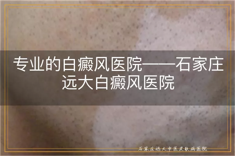 专业的白癜风医院——石家庄远大白癜风医院