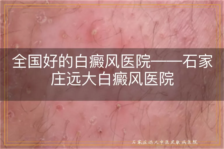 全国好的白癜风医院——石家庄远大白癜风医院