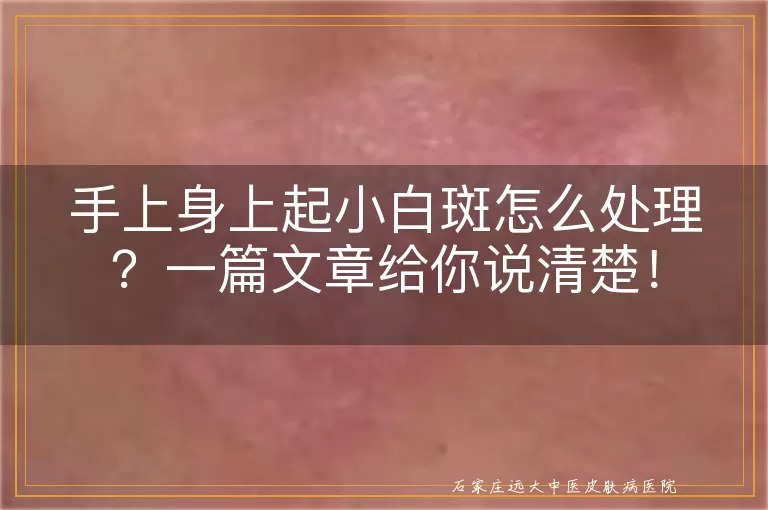 手上身上起小白斑怎么处理？一篇文章给你说清楚！