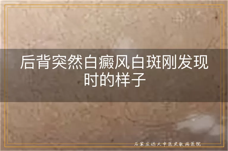 后背突然白癜风白斑刚发现时的样子