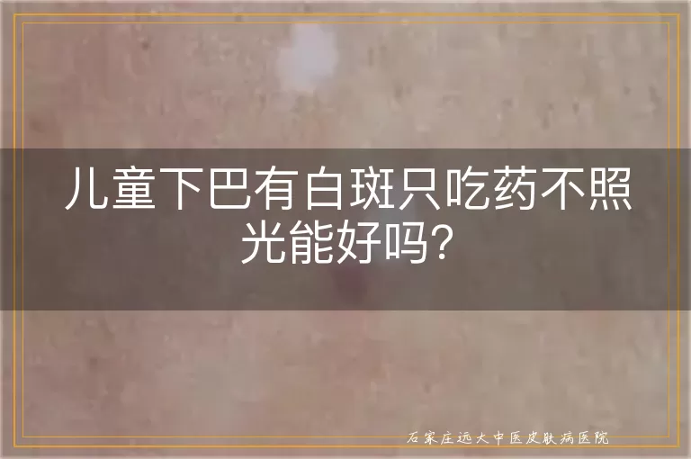 儿童下巴有白斑只吃药不照光能好吗？