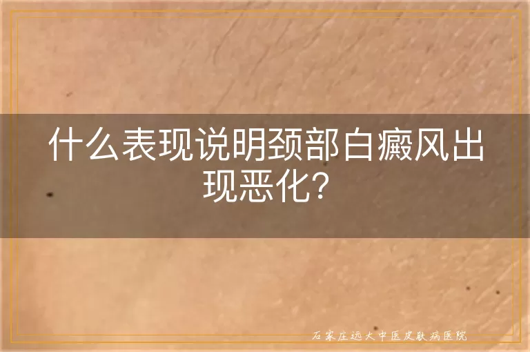 什么表现说明颈部白癜风出现恶化？