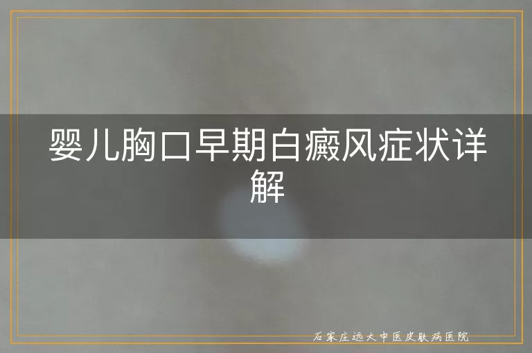 婴儿胸口早期白癜风症状详解