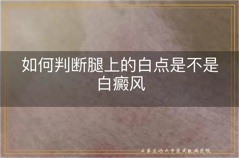 如何判断腿上的白点是不是白癜风