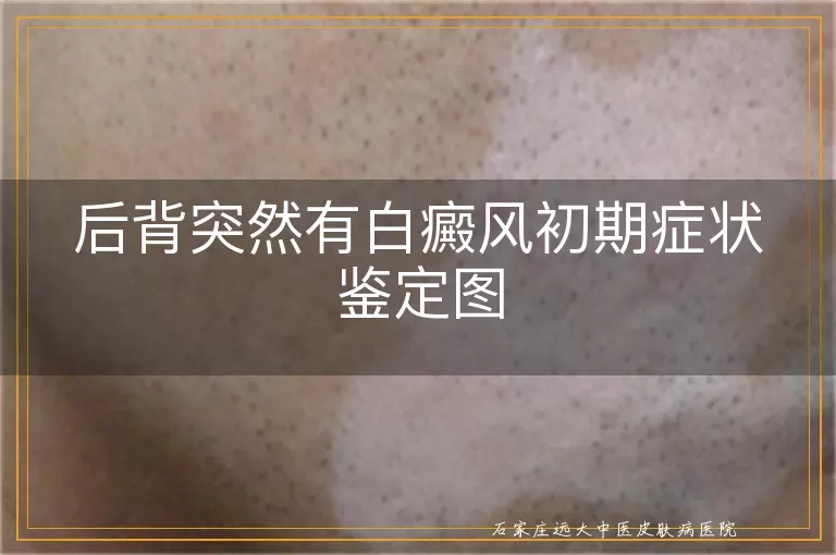 后背突然有白癜风初期症状鉴定图