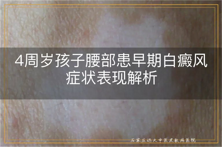 4周岁孩子腰部患早期白癜风症状表现解析