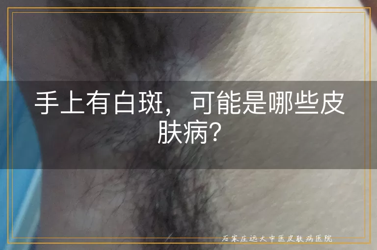 手上有白斑，可能是哪些皮肤病？