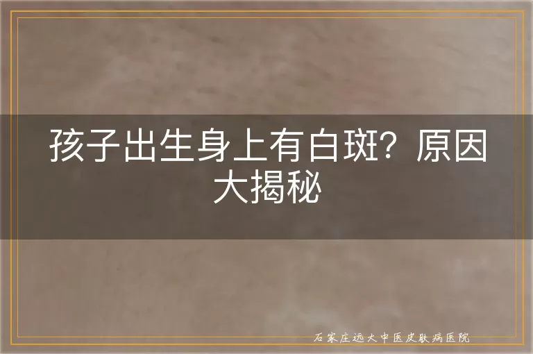 孩子出生身上有白斑？原因大揭秘