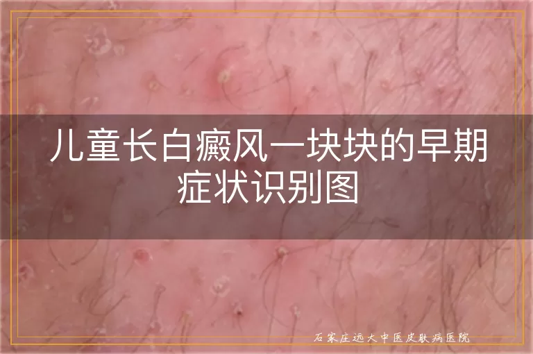 儿童长白癜风一块块的早期症状识别图