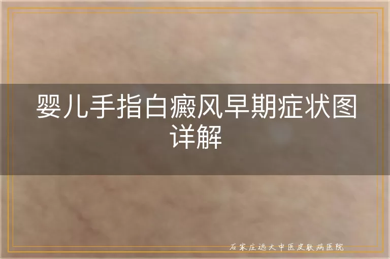 婴儿手指白癜风早期症状图详解