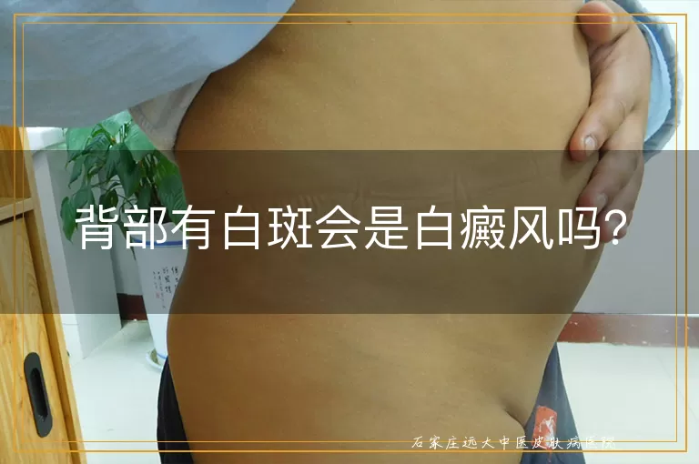 背部有白斑会是白癜风吗？