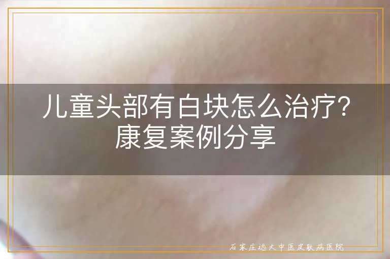 儿童头部有白块怎么治疗？康复案例分享