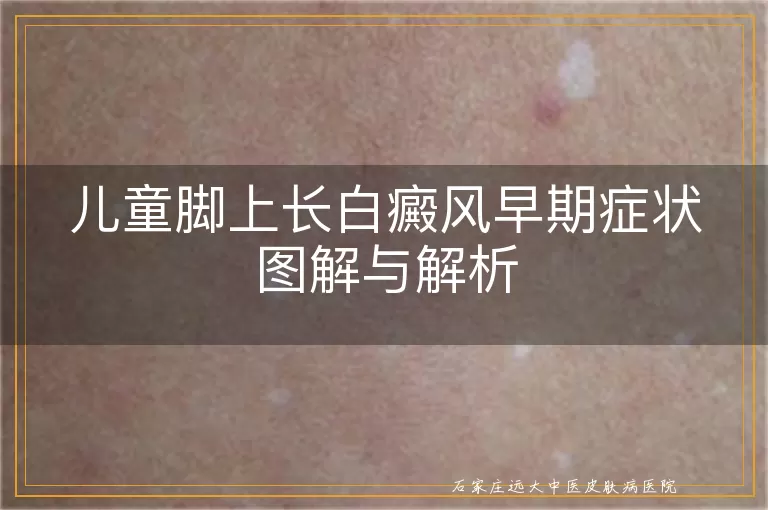 儿童脚上长白癜风早期症状图解与解析