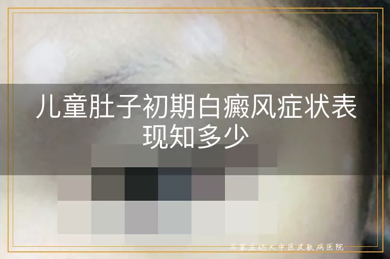 儿童肚子初期白癜风症状表现知多少