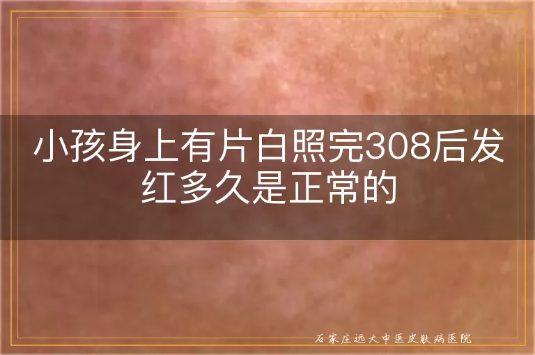 小孩身上有片白照完308后发红多久是正常的