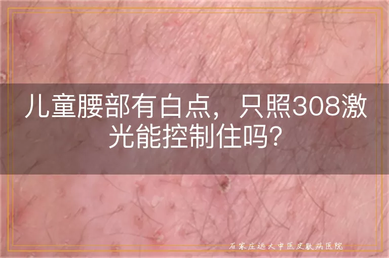 儿童腰部有白点，只照308激光能控制住吗？