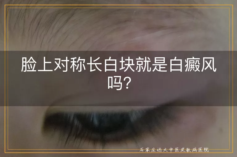 脸上对称长白块就是白癜风吗？