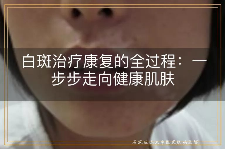 白斑治疗康复的全过程：一步步走向健康肌肤