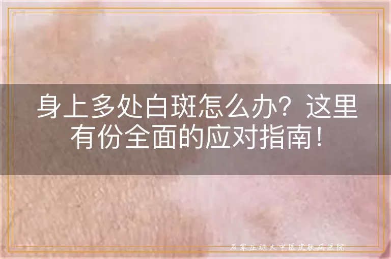 身上多处白斑怎么办？这里有份全面的应对指南！