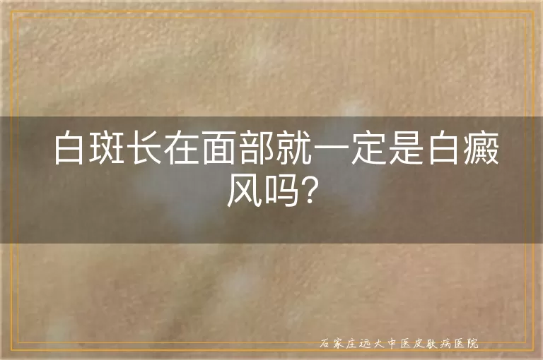 白斑长在面部就一定是白癜风吗？