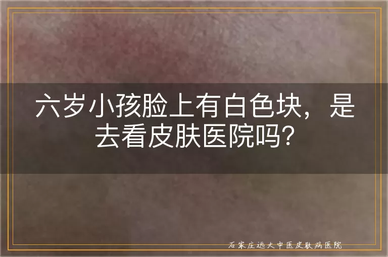 六岁小孩脸上有白色块，是去看皮肤医院吗？