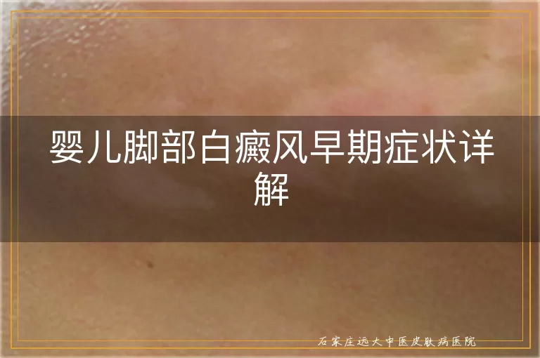 婴儿脚部白癜风早期症状详解