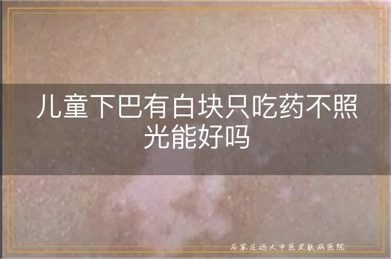 儿童下巴有白块只吃药不照光能好吗