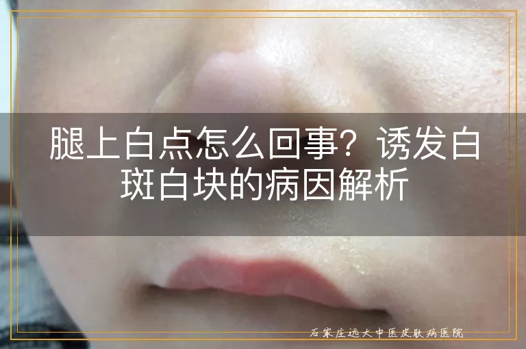 腿上白点怎么回事？诱发白斑白块的病因解析