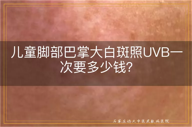 儿童脚部巴掌大白斑照UVB一次要多少钱？