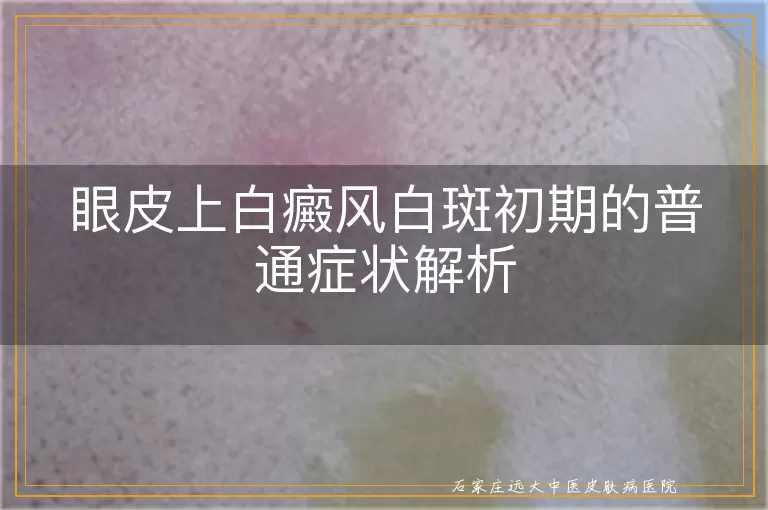 眼皮上白癜风白斑初期的普通症状解析