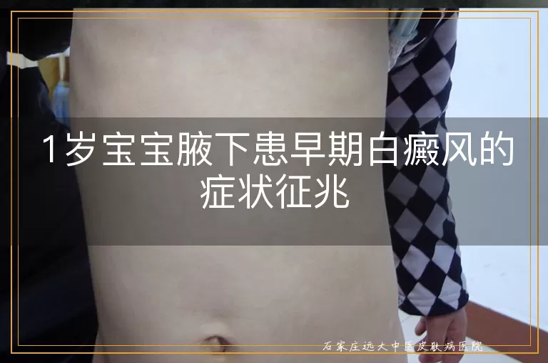 1岁宝宝腋下患早期白癜风的症状征兆