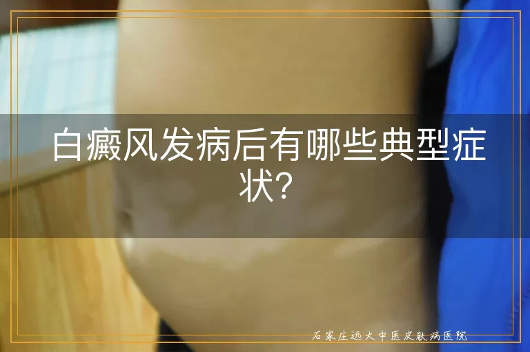 白癜风发病后有哪些典型症状？