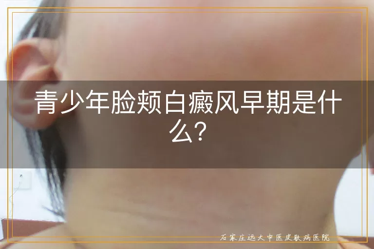 青少年脸颊白癜风早期是什么？