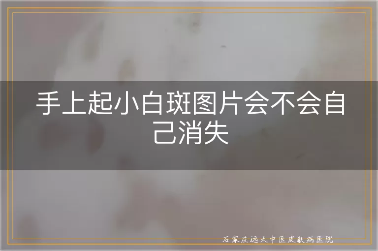 手上起小白斑图片会不会自己消失